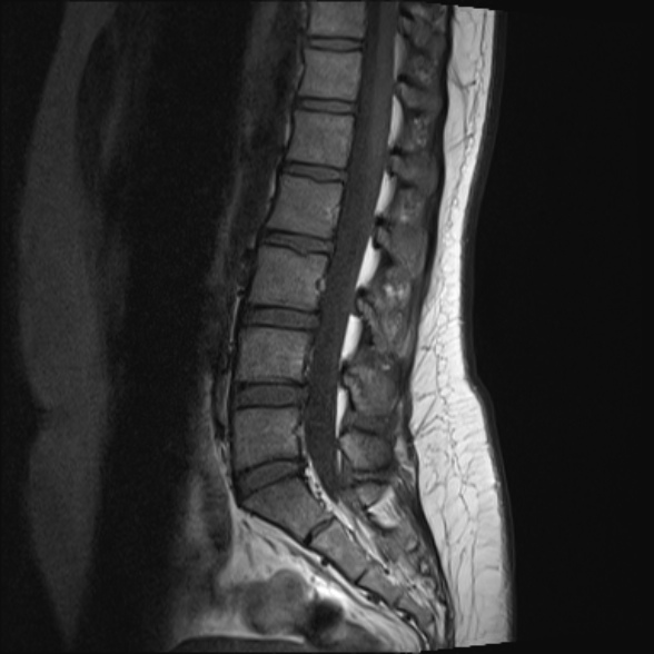 File:Normal lumbar spine MRI- 3 T (Radiopaedia 53280-59250 Sagittal T1 13).jpg