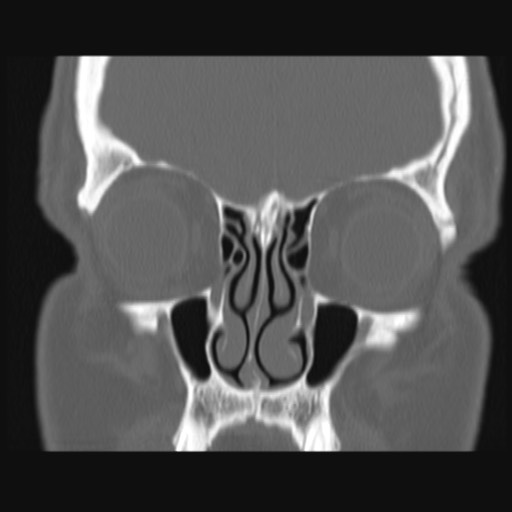 Normal sinus CT (annotated) (Radiopaedia 78917-91810 Coronal bone window 22).jpg