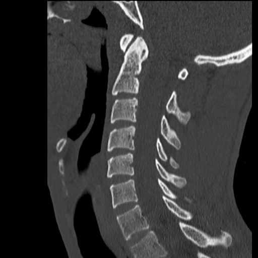 File:Normal trauma cervical spine (Radiopaedia 41017-43760 Sagittal bone window 22).png