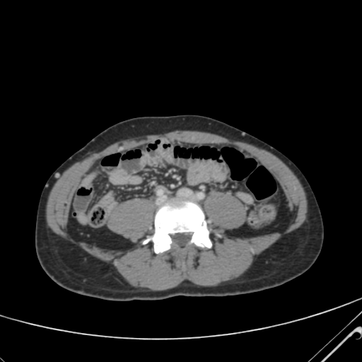 File:Nutmeg liver- Budd-Chiari syndrome (Radiopaedia 46234-50635 B 46).png