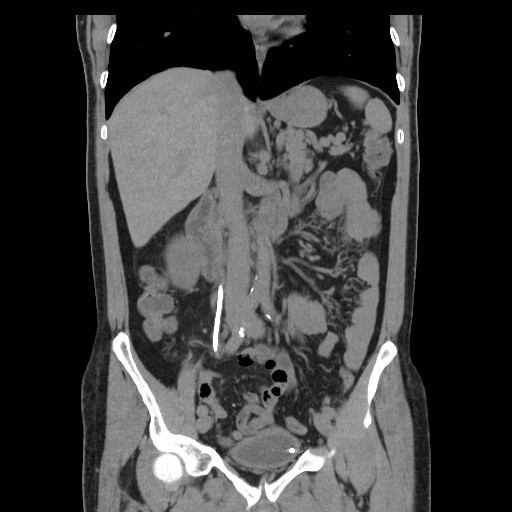File:Obstructed kidney with perinephric urinoma (Radiopaedia 26889-27067 Coronal non-contrast 4).jpg