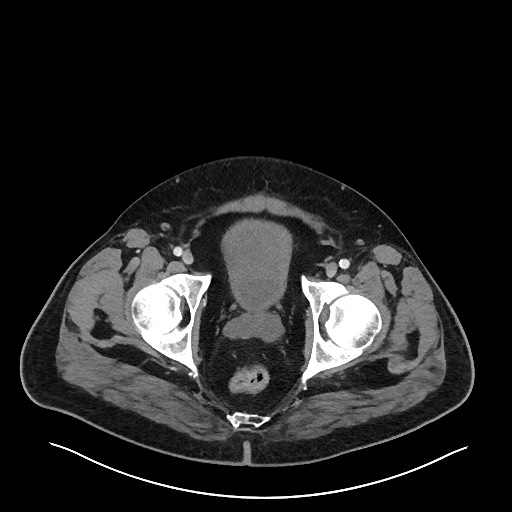File:Obstructing sigmoid adenocarcinoma (Radiopaedia 58465-65619 Axial 120).jpg