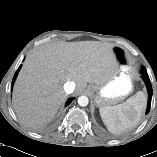File:Obstructive superior vena cava tumor thrombus (Radiopaedia 28046-28306 A 49).jpg