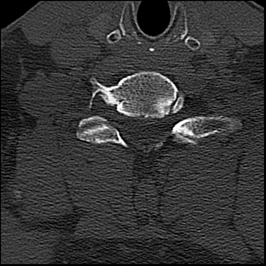 Occipital condyle fracture (type 1) (Radiopaedia 87670-104084 Axial bone window 69).jpg