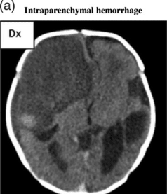 CT scan shows a very large intraparenchymal haemorrhage with mass effect and occupying most of the right frontal lobe