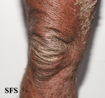 File:Psoriasis (Dermatology Atlas 69).jpg