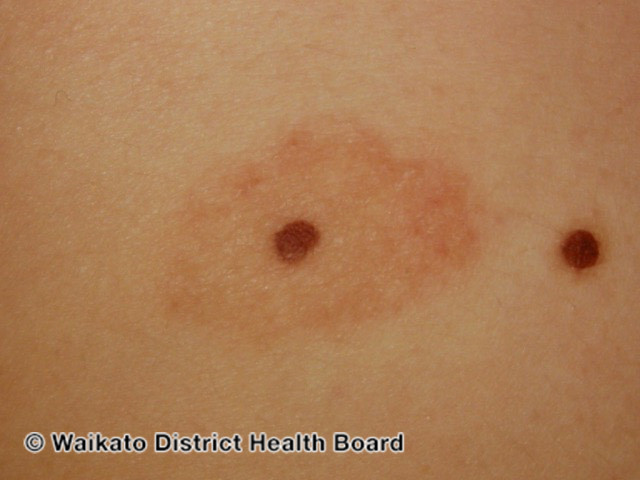 File:See more images of halo naevi. (DermNet NZ lesions-w-meyerson5).jpg