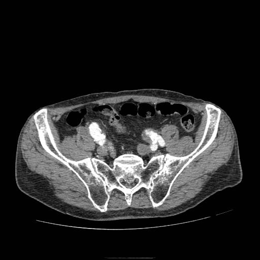 Abdominal aortic aneurysm (Radiopaedia 13341-13340 Axial C+ arterial phase 188).jpg