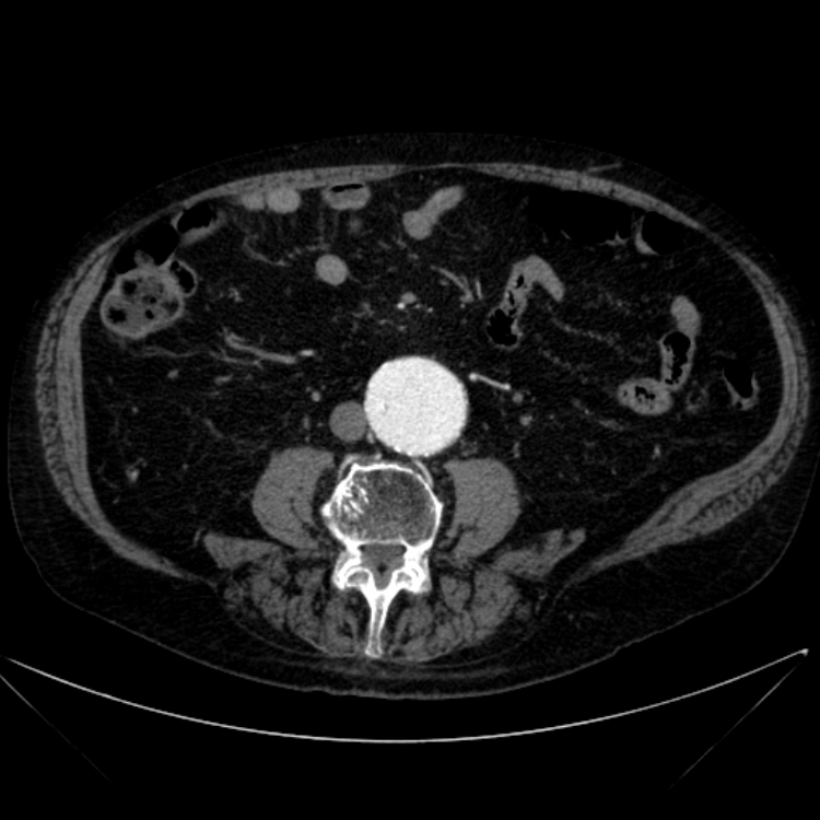 Abdominal aortic aneurysm (Radiopaedia 25855-26001 Axial C+ arterial phase 77).jpg