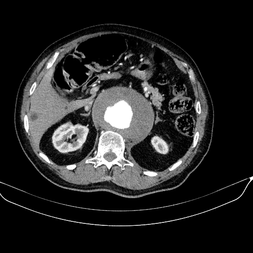 File:Abdominal aortic aneurysm (Radiopaedia 67117-76452 Axial C+ arterial phase 44).jpg