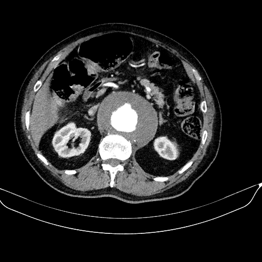 Abdominal aortic aneurysm (Radiopaedia 67117-76452 Axial C+ arterial phase 46).jpg