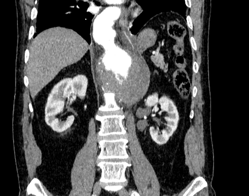Abdominal aortic aneurysm (Radiopaedia 67117-76452 Coronal C+ arterial phase 62).jpg