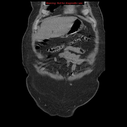 File:Abdominal aortic aneurysm (Radiopaedia 8190-9038 Coronal C+ arterial phase 20).jpg