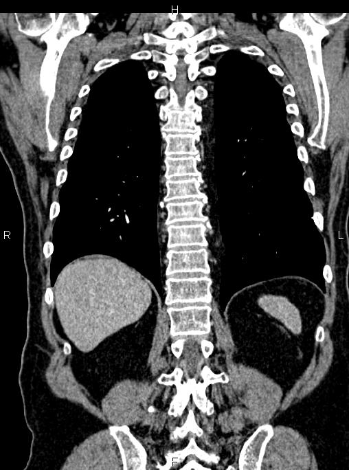 Abdominal aortic aneurysm (Radiopaedia 83094-97462 Coronal renal cortical phase 70).jpg