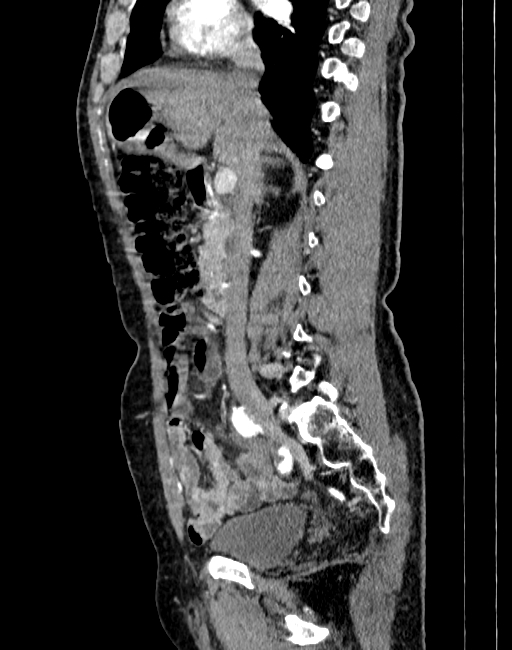 Abdominal aortic aneurysm (Radiopaedia 83581-98689 Sagittal C+ arterial phase 23).jpg