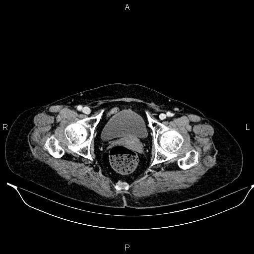 File:Abdominal aortic aneurysm (Radiopaedia 85063-100606 Axial C+ portal venous phase 63).jpg