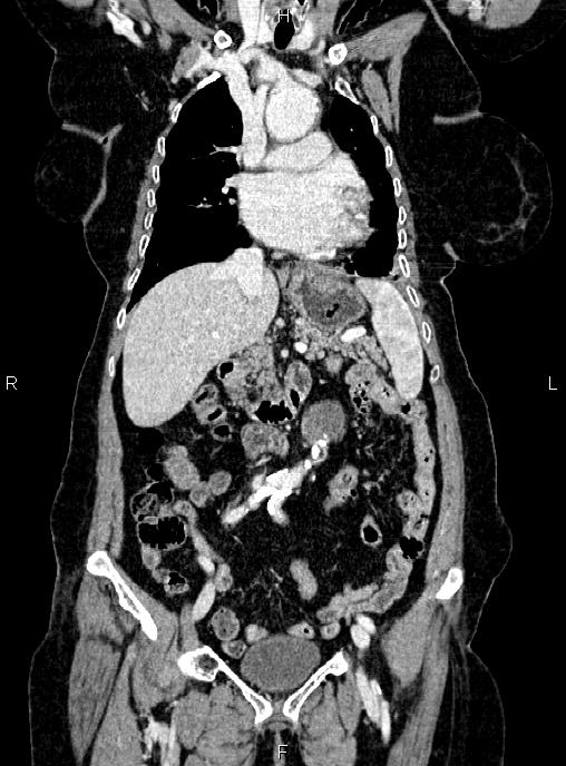 Abdominal aortic aneurysm (Radiopaedia 85063-100606 Coronal C+ arterial phase 22).jpg
