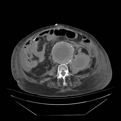 Abdominal aortic aneurysm - impending rupture (Radiopaedia 19233-19247 Axial non-contrast 98).jpg