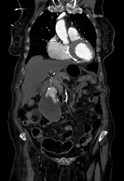Abdominal aortic aneurysm with thrombus fissuration (Radiopaedia 73192-83919 Coronal C+ arterial phase 19).jpg
