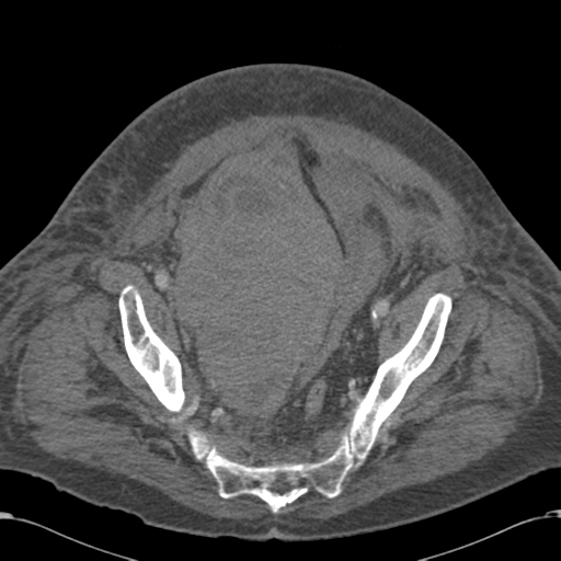 Abdominal hematoma (Radiopaedia 33614-34715 Axial C+ portal venous phase 110).png