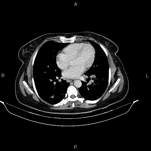 File:Abdominal lymphoma with sandwich sign (Radiopaedia 84378-99704 Axial C+ portal venous phase 2).jpg