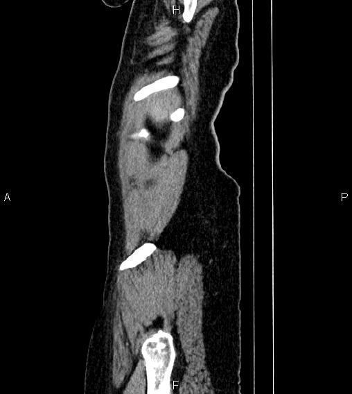 File:Abdominal lymphoma with sandwich sign (Radiopaedia 84378-99704 Sagittal C+ portal venous phase 91).jpg