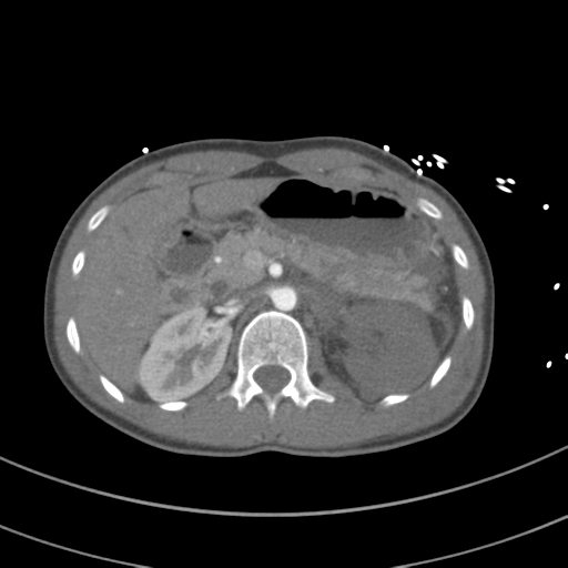File:Abdominal multi-trauma - devascularised kidney and liver, spleen and pancreatic lacerations (Radiopaedia 34984-36486 Axial C+ arterial phase 101).png