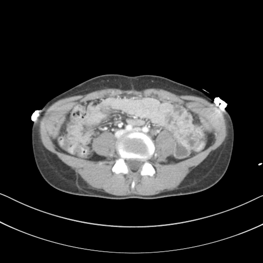 Abdominal multi-trauma - devascularised kidney and liver, spleen and pancreatic lacerations (Radiopaedia 34984-36486 Axial C+ portal venous phase 51).png