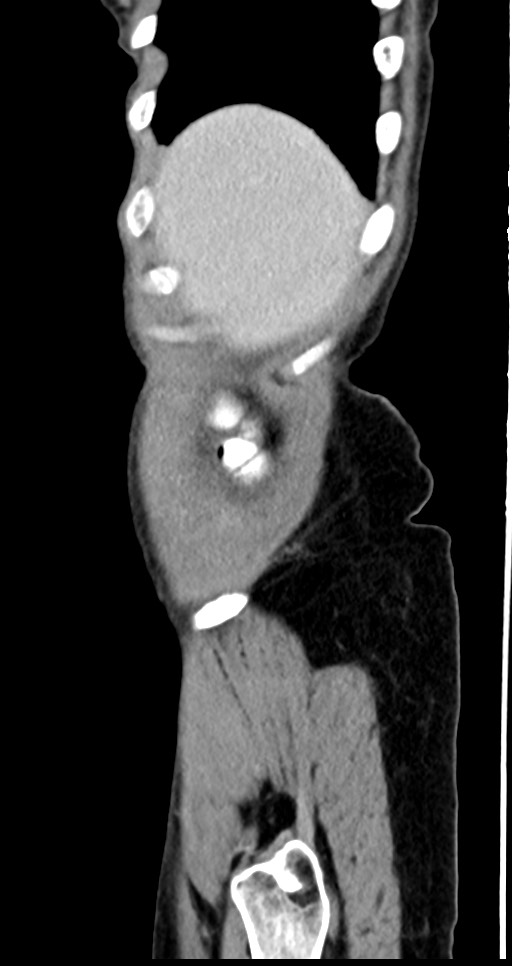 Abdominal wall and retroperitoneal tuberculosis (Radiopaedia 88137-104729 Sagittal C+ portal venous phase 135).jpg