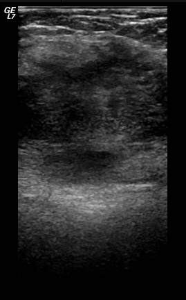 File:Abdominal wall endometriosis (Radiopaedia 25723-25886 A 4).jpg