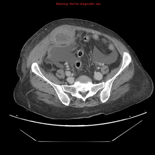 File:Abdominal wall hematoma (Radiopaedia 9427-10112 Axial C+ portal venous phase 79).jpg