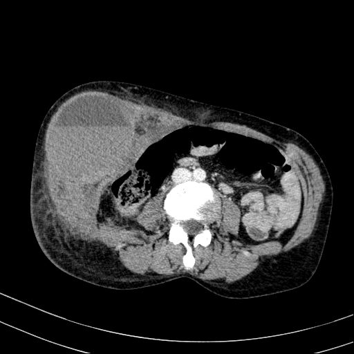 Abdominal wall hematoma with active bleeding (Radiopaedia 83915-99117 Axial C+ portal venous phase 53).jpg