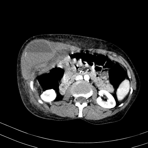 Abdominal wall hematoma with active bleeding (Radiopaedia 83915-99117 Axial renal cortical phase 33).jpg