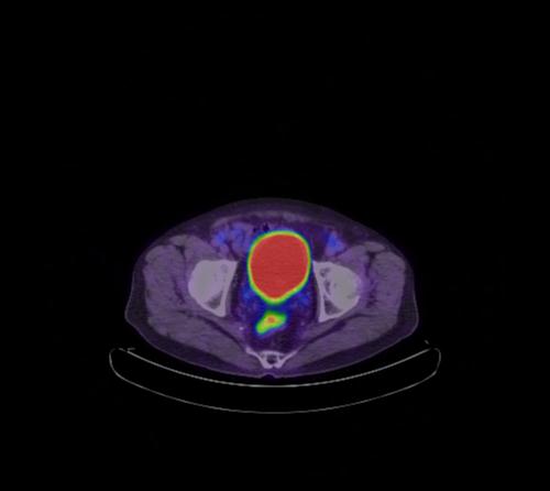 Abdominal wall metastasis from colorectal carcinoma (Radiopaedia 31016-31719 Axial 29).jpg