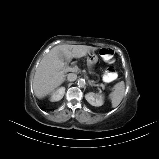 File:Abdominal wall recurrence after colorectal resection for cancer (Radiopaedia 23444-23523 Axial C+ portal venous phase 6).jpg