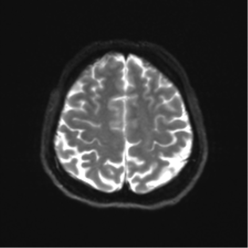 File:Abducens nerve palsy (Radiopaedia 51069-56648 Axial DWI 21).png