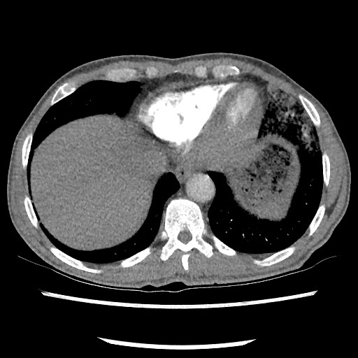Accessory left horizontal fissure with lingular pneumonia (Radiopaedia 53763-59843 Axial C+ CTPA 74).jpg