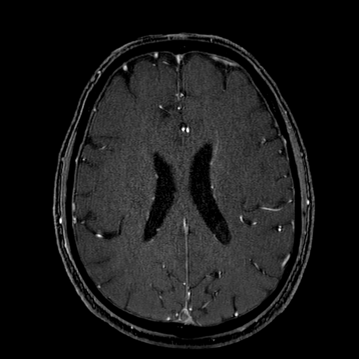 Accessory middle cerebral artery (Radiopaedia 73114-83828 Axial MRA 136).jpg