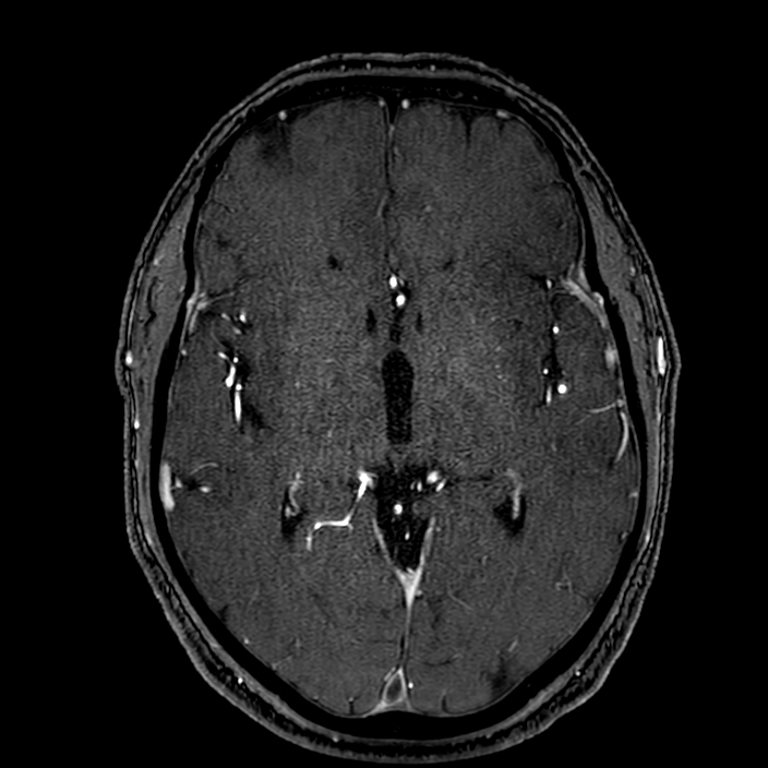 Accessory middle cerebral artery (Radiopaedia 73114-83828 Axial MRA 97).jpg