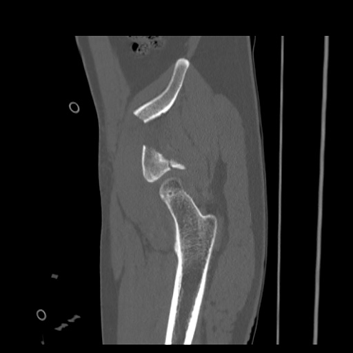 Acetabular and ilial fractures (Radiopaedia 59084-66378 Sagittal bone window 16).jpg