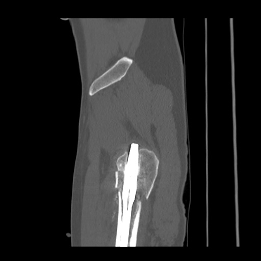 Acetabular and ilial fractures (Radiopaedia 59084-66378 Sagittal bone window 92).jpg