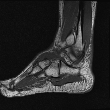 File:Achilles tendon tear (Radiopaedia 77615-89819 Sagittal T1 17).jpg