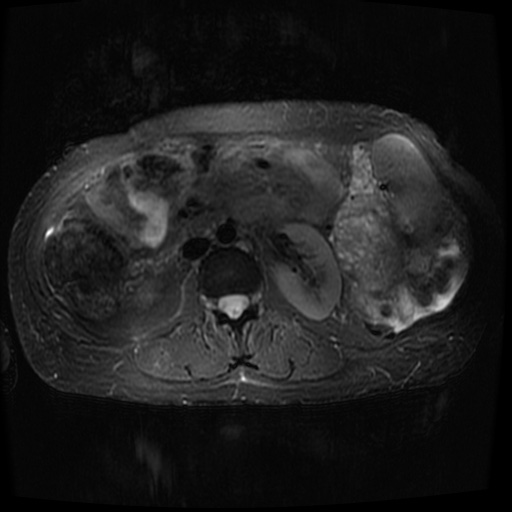 Acinar cell carcinoma of the pancreas (Radiopaedia 75442-86668 Axial T2 fat sat 46).jpg