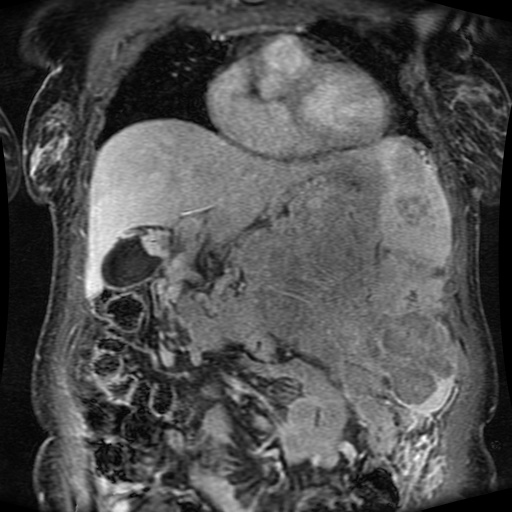 Acinar cell carcinoma of the pancreas (Radiopaedia 75442-86668 Coronal T1 C+ fat sat 127).jpg
