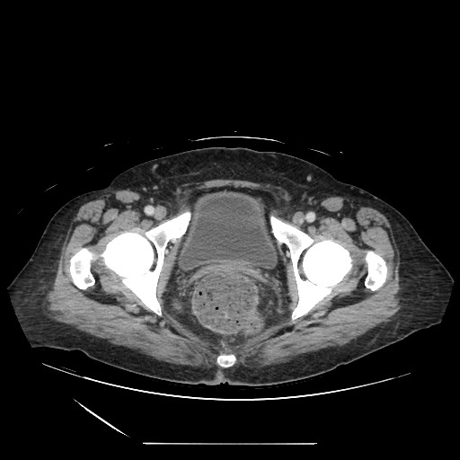 File:Acinar cell carcinoma of the pancreas (Radiopaedia 75442-86669 Axial C+ portal venous phase 141).jpg