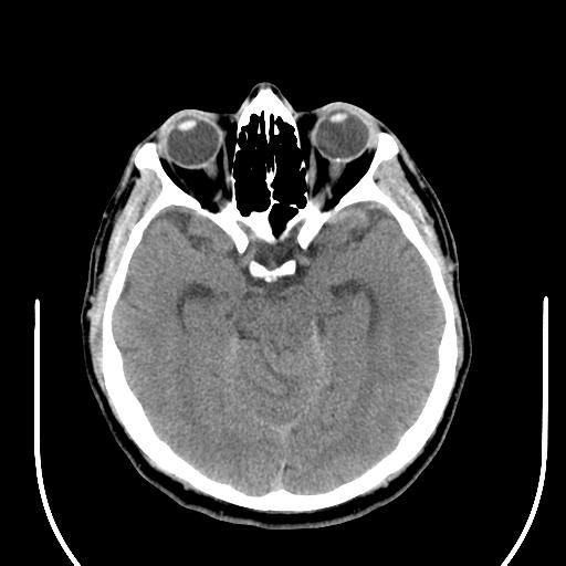 File:Acoustic schwannoma (Radiopaedia 29488-29982 AXIAL THICK non-contrast 19).jpg