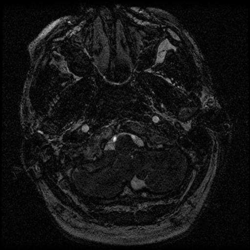 File:Acoustic schwannoma (Radiopaedia 39170-41387 Axial FIESTA 13).png