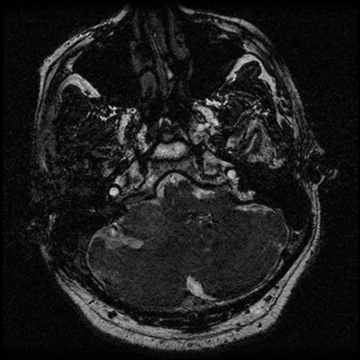 File:Acoustic schwannoma (Radiopaedia 39170-41387 Axial FIESTA 46).png