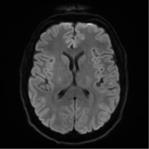 Acoustic schwannoma (Radiopaedia 50846-56358 Axial DWI 44).png