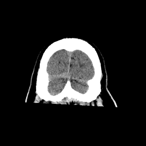 File:Acoustic schwannoma (Radiopaedia 55729-62280 Coronal non-contrast 37).png